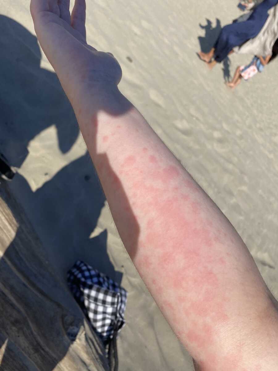rash on the arm of a chronically ill woman