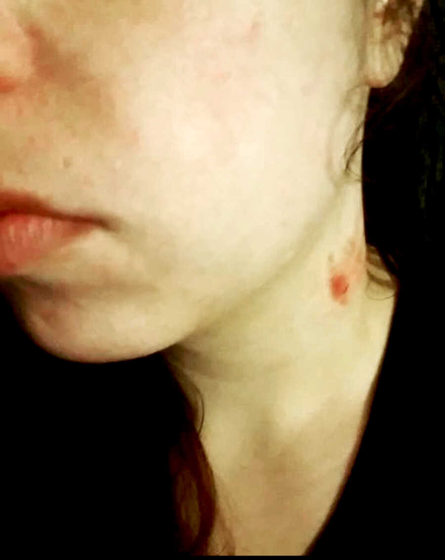 red mark on neck caused by violence from partner