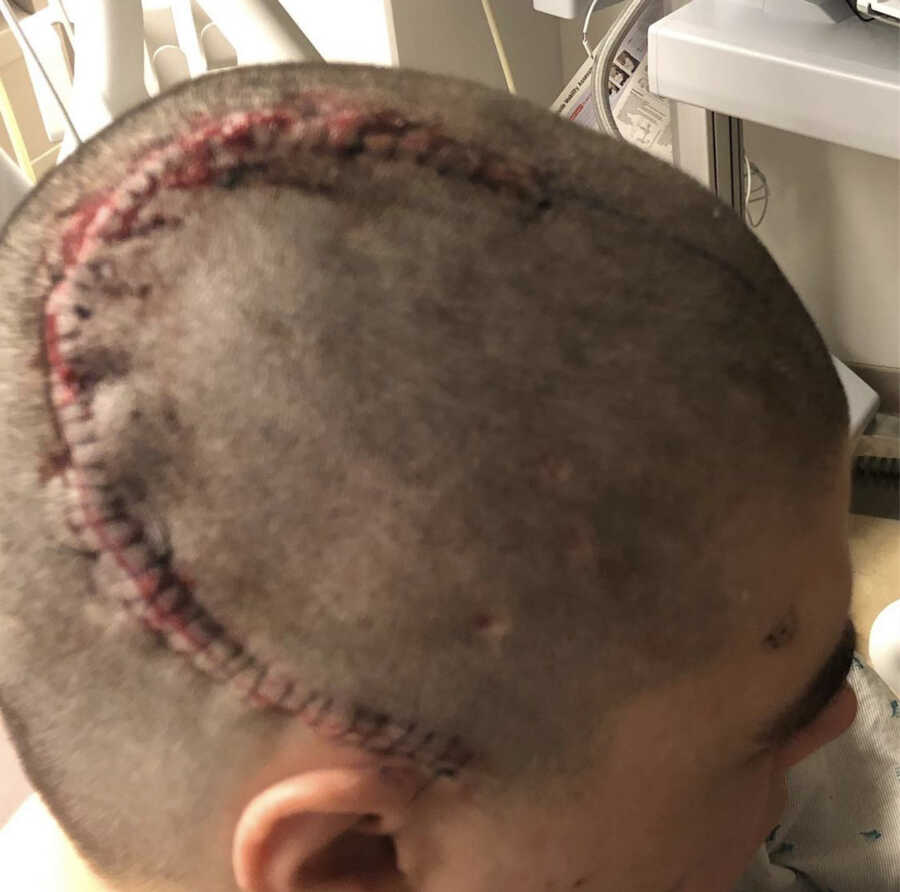 incision from brain surgery with staples