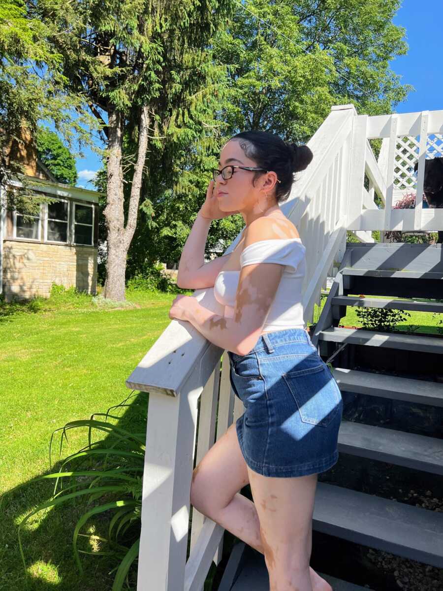 girl with vitiligo stands on stairs outside in a denim skirt and white top