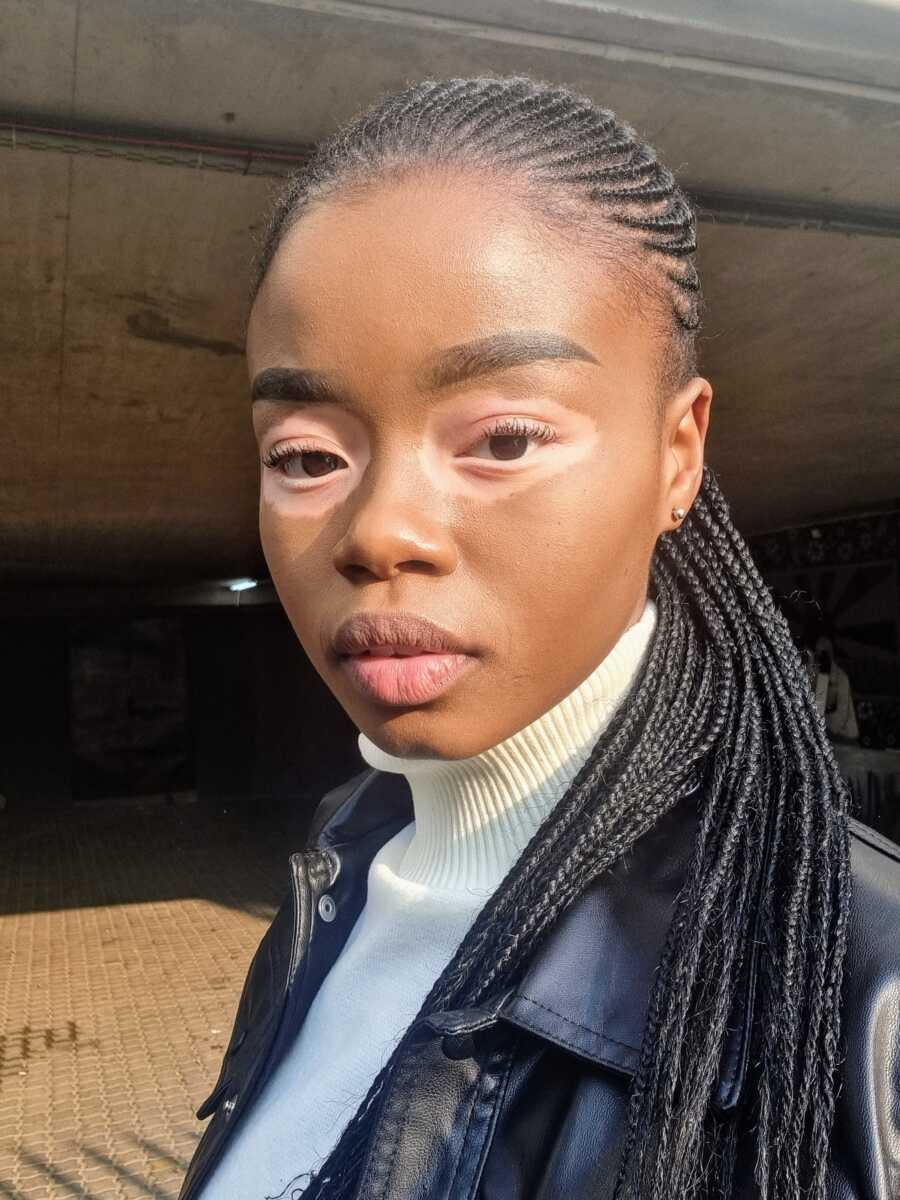 woman with vitiligo wearing black jacket outside