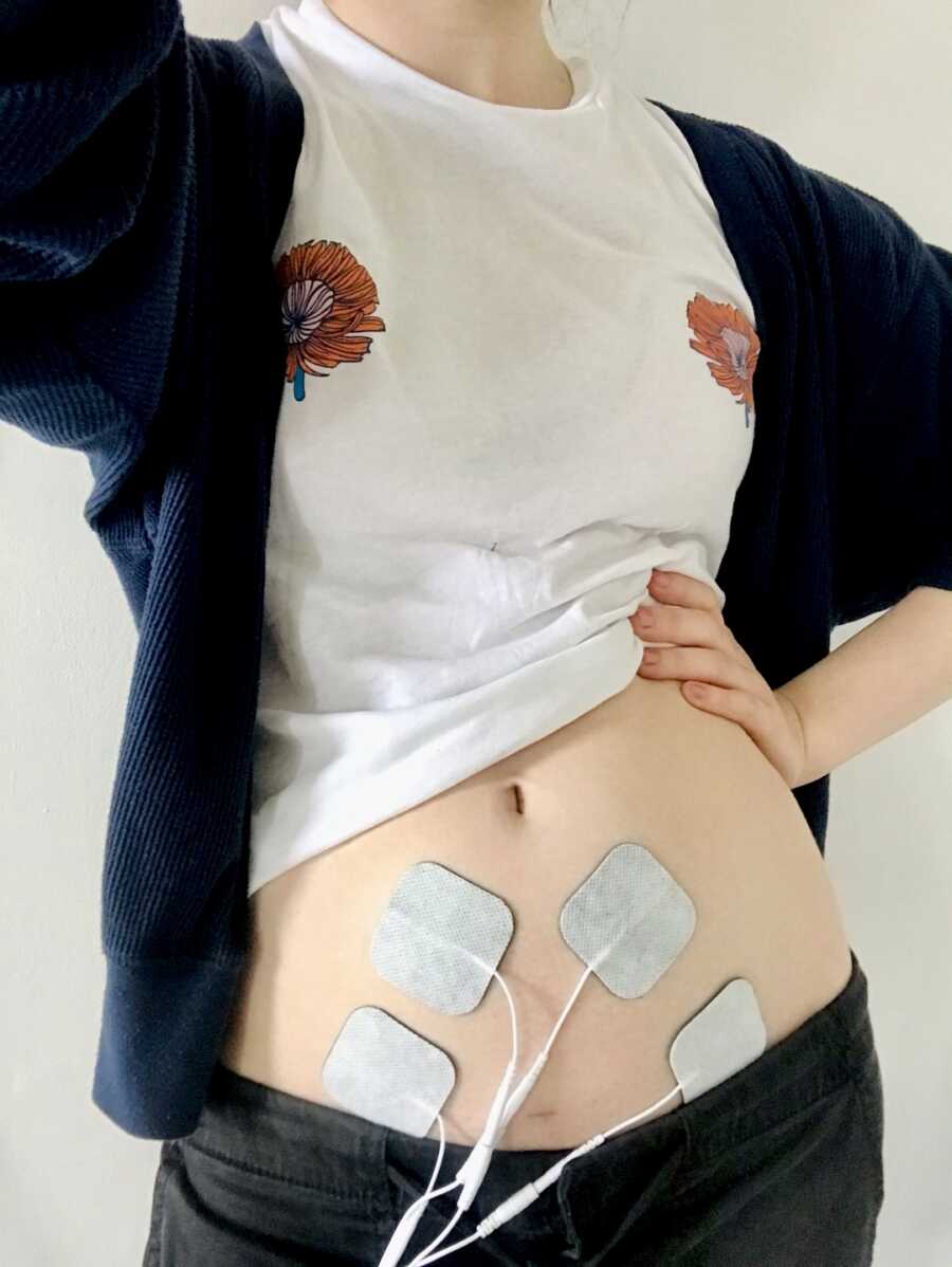 torso of woman with endometriosis with TENS machine on