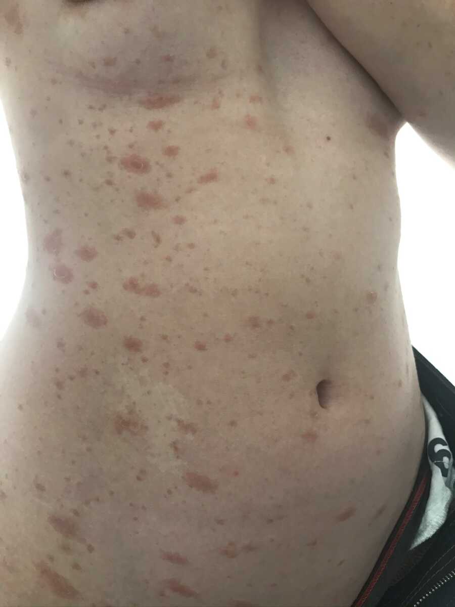 rash on the torso of woman with endometriosis