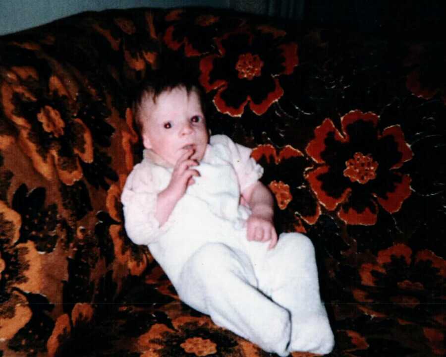 infant with Treacher Collins Syndrome sitting on couch