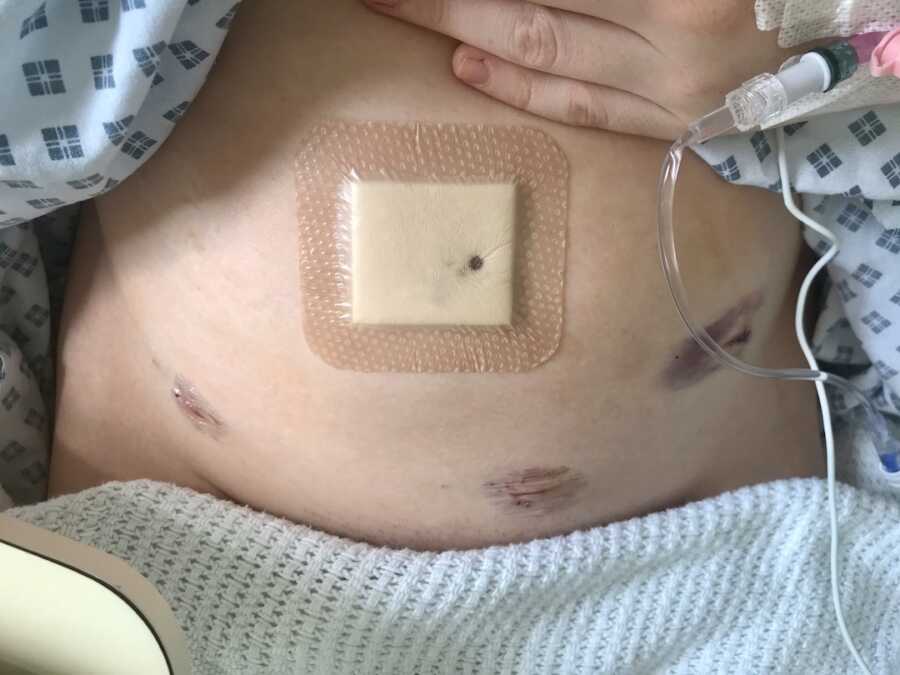 incision marks on torso after surgery for endometriosis