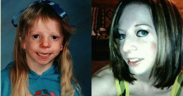 woman who lives with Treacher Collins Syndrome
